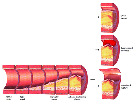 Plaque formation in atherosclerosis